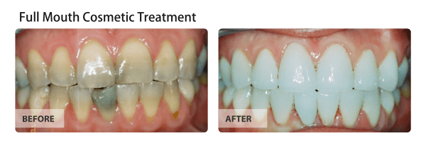 Full Mouth Cosmetic Treatment